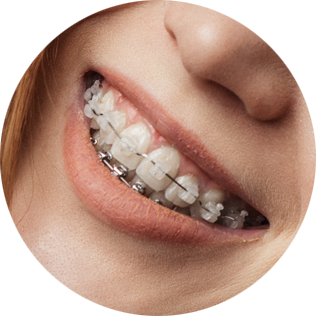 Patient with clear braces